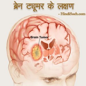 ब्रेन ट्यूमर के लक्षण व कारण - Brain Tumor Symptoms in Hindi