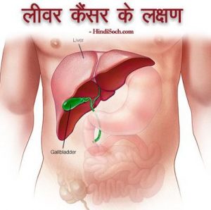 Liver Cancer Ke Lakshan