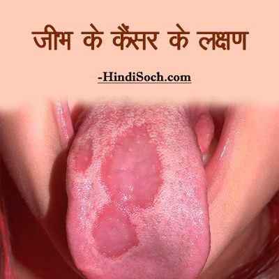 Tongue Cancer Symptoms in Hindi